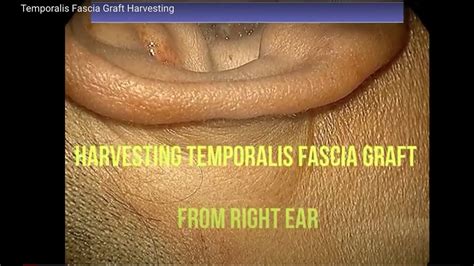 Temporalis fascia graft on upper lip